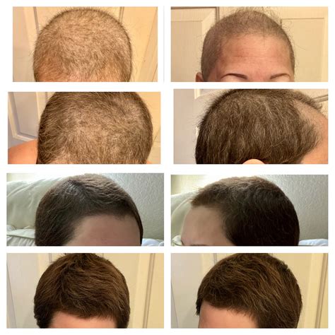 DigniCaps multi-center clinical trial resulted in 66. . Hair regrowth during weekly taxol